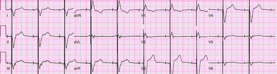 Paced rhythm — pacing spike preceding wide QRS