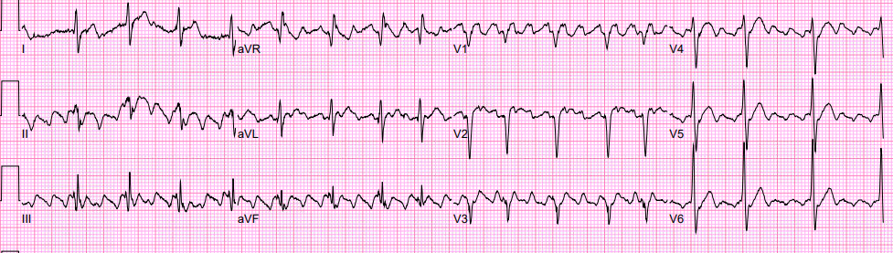 Typical CTI-dependent flutter — ablation endpoint is bidirectional block across the cavotricuspid isthmus
