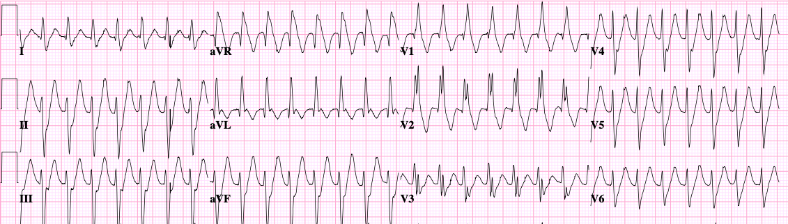 Monomorphic VT — mapping identifies critical isthmus
